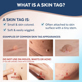 Claritag Advanced Skin Tag Remover - FDA-Cleared Device - Only for Skin Tag