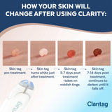 Claritag Advanced Skin Tag Remover - FDA-Cleared Device - Only for Skin Tag